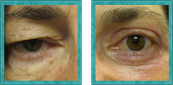Blepharoplasty (Eyelid lift)