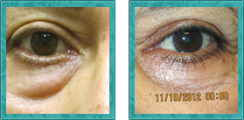Cosmetic Lower Eyelid Blepharoplasty